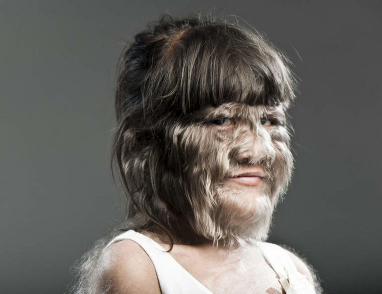 Самая волосатая девочка: Супатра Сасупфан